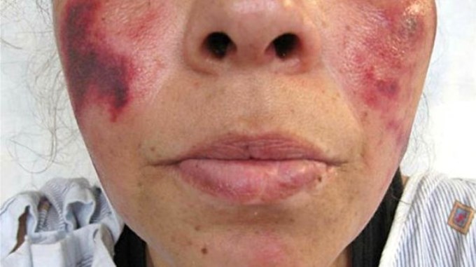 Sustancia "pudre" la carne de los adictos a la coca&iacute;na