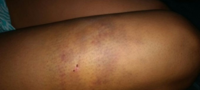 Denuncia que su ex la moli&oacute; a golpes