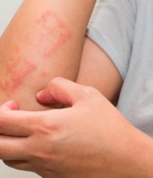 Psoriasis: un mal que estigmatiza