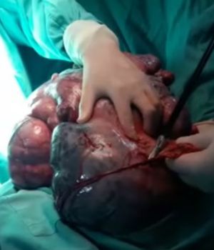 Extirpan tumor de 20 kilos a abuela de 72 a&ntilde;os